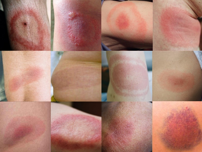 jak wygląda rumień wędrujący po ukąszeniu kleszcza